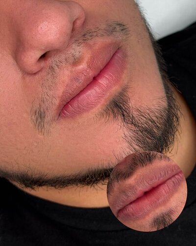 Lip Neutralization New York
