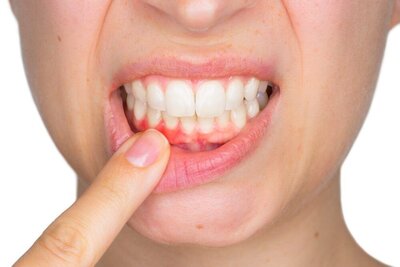Swelling after dental surgery at Peak Prosthodontics in Lethbridge is normal—apply ice packs in 20-minute intervals during the first 24 hours to reduce discomfort.
