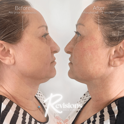 Ottawa and Gatineau's best cosmetic injectables clinic to get morpheus8 and radiofrequency microneedling