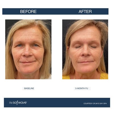 Set-75-Full-Face