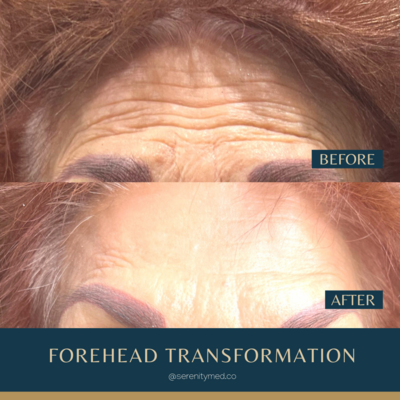 botox for forehead