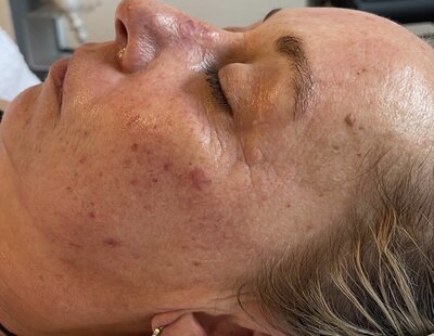 avant après du jet peel