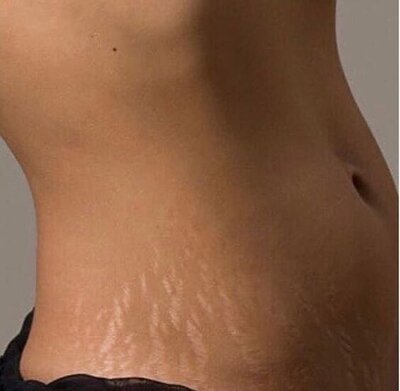 LASERDERM WEBSITE - STRETCH MARKS