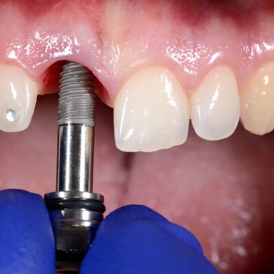 A prosthodontist performing a dental implant procedure as part of expert prosthodontics referrals for tooth restoration at Peak Prosthodontics in Lethbridge, Alberta.