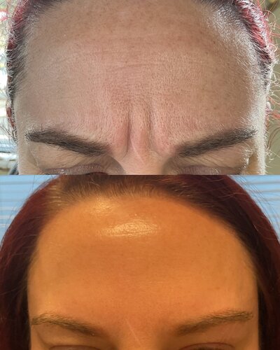 Dysport and Botox before and after