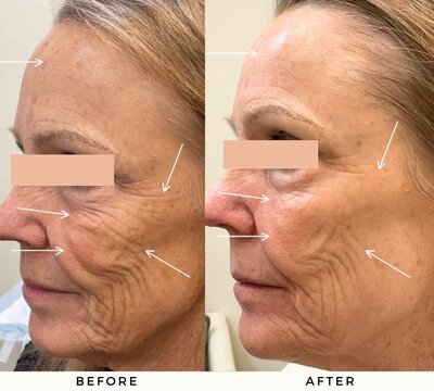 Microneedling BeforeAfter Revival 1