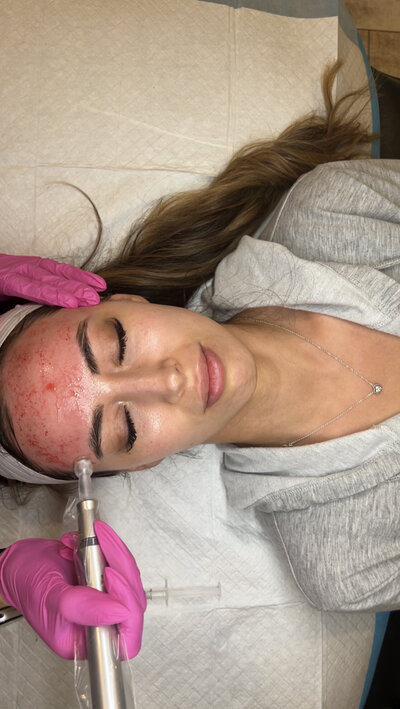 microneedling pic