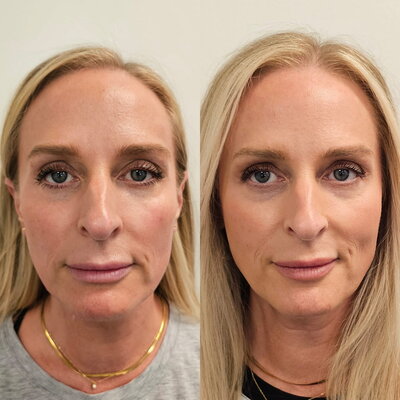 Sculptra facial filler before and after

