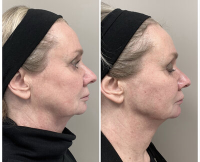 Before after liquid facelift Lizenka Adriaanse cosmetisch arts Rotterdam