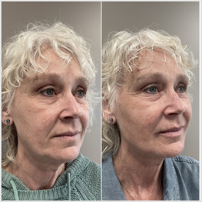 Liquid facelift door cosmetisch arts Lizenka Adriaanse in Rotterdam