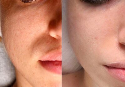 infirmière-esthétique-jet-peel-brignoles