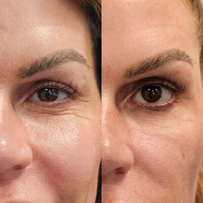PDGF under eye treatment results

