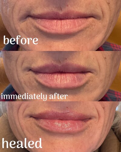Lip filler before and after photo