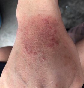 avant après du jet peel