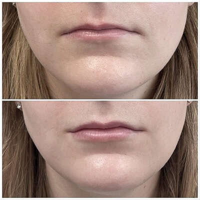 Lipfillers door cosmetisch arts Lizenka Adriaanse in Rotterdam
