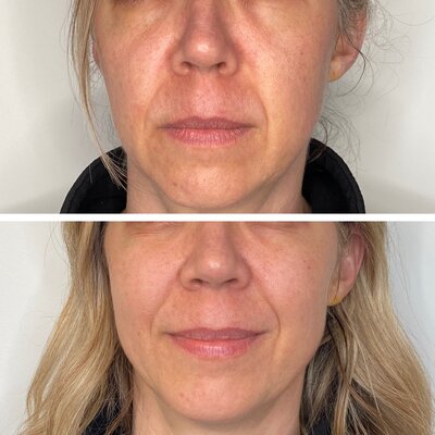 Non-invasive Jet Peel skincare