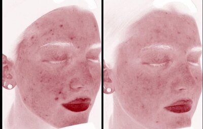 Clear skin program before and after