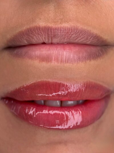Dark Lip Neutralization