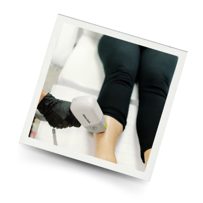 laser hair removal
