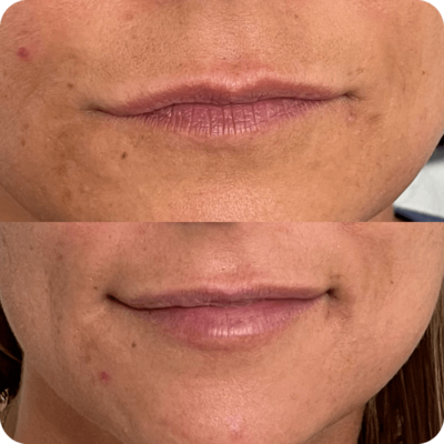 Lip augmentation service before and after results
