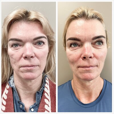 Liquid facelift Lizenka Adriaanse cosmetisch arts Rotterdam