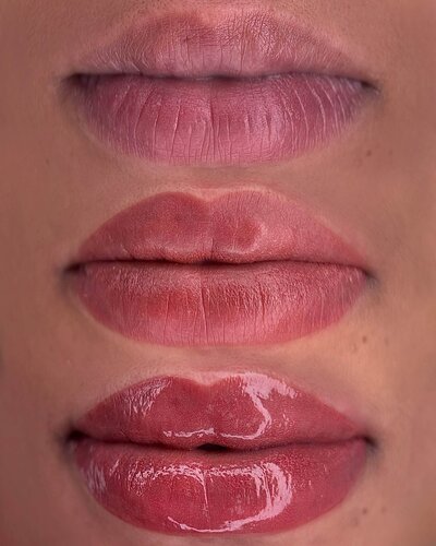 Lip Neutralization New York