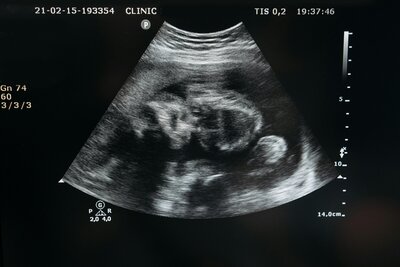 Ultrasound image showing a developing baby in the womb