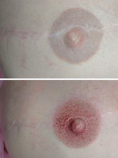 areola_new