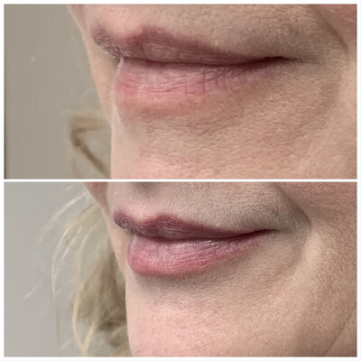 Lipfillers door cosmetisch arts Lizenka Adriaanse in Rotterdam