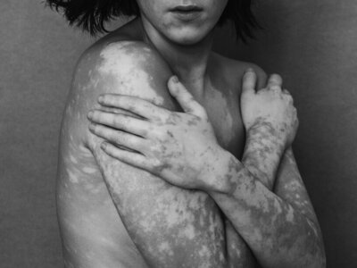 Close up black and white nude photography of someone with Vitiligo covering their chest with crossed arms.