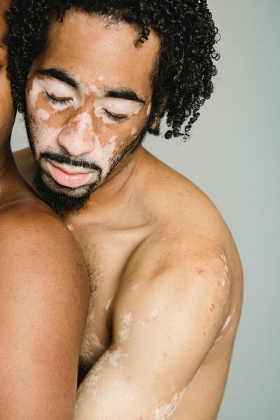 Black man with Vitiligo embraces another man from behind