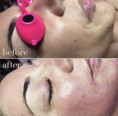 Before-After-Facial-Dermatude-LEDLight-Results