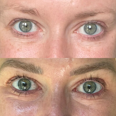 Before and after photo of woman with Botox