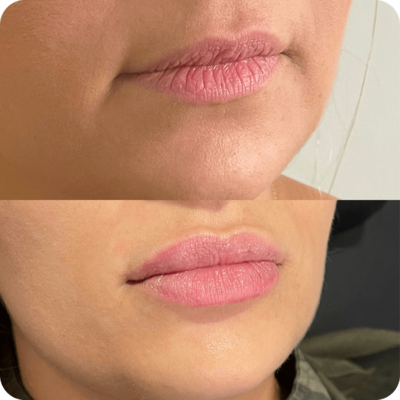 Before and after lip injectable services