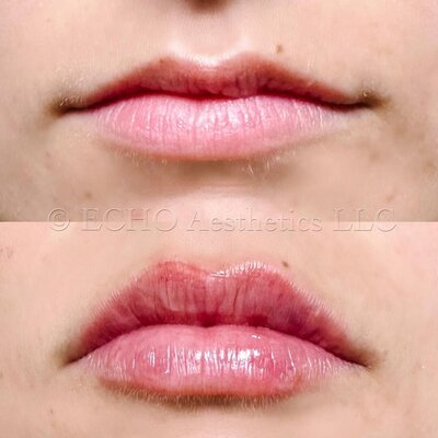 Botox Injection Results in Scottsdale