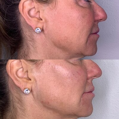Jaw line fillers at Refresh Aesthetics
