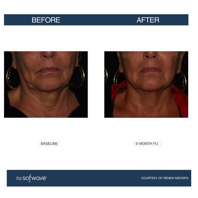 Set-85-Lower-Face-Neck (1)