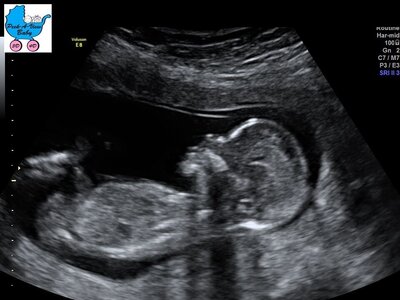 Baby's head shown in 2D Ultrasound Image