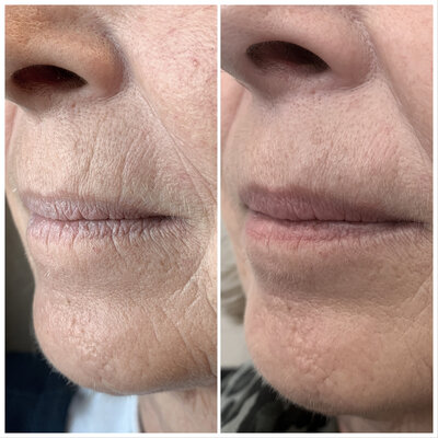 Lipfillers door cosmetisch arts Lizenka Adriaanse in Rotterdam