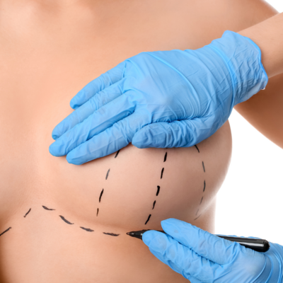 Image of woman having incision marks drawn on chest area