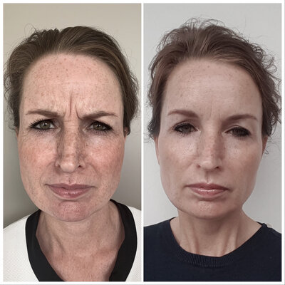 Botox before after door Lizenka Adriaanse cosmetisch arts Rotterdam