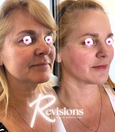 Ottawa and Gatineau's best clinic for thread lift