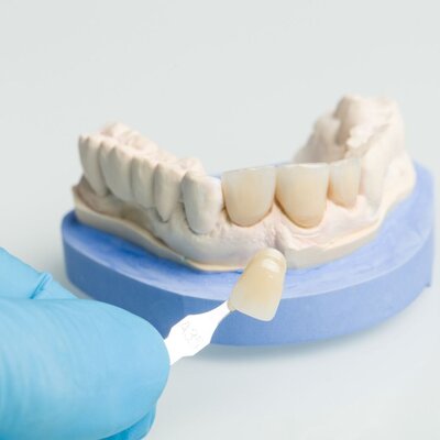 Dental crowns being carefully crafted at Peak Prosthodontics in Lethbridge, Alberta to perfectly match a patient's smile.