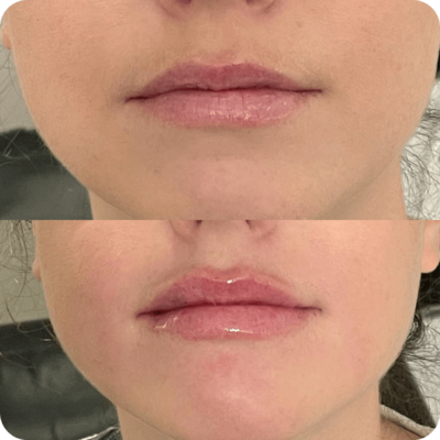 Before and after results lip filler service