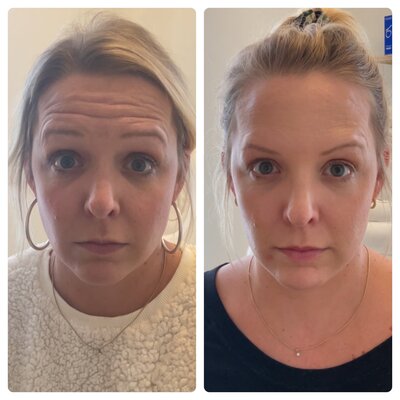 Facial injectables treatment using Botox and fillers at a Burlington aesthetics clinic.