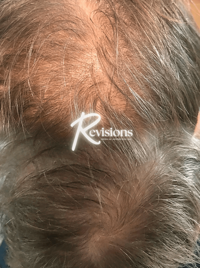 Ottawa and Gatineau's best cosmetic injectables clinic to get biorevitalization collagen boosting and stimulating medical-grade facial