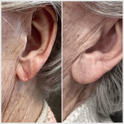Fillers mondhoeken door cosmetisch arts Lizenka Adriaanse in Rotterdam