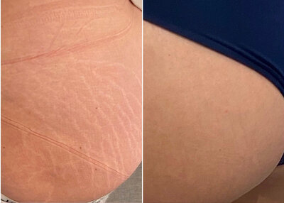 Inkless tattoo client before and after on upper thigh by Vamp Cosmetic