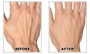 2359_dlk-radiesse-injectable-filler-hand-before-after-toronto_1