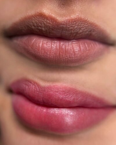 Lip Neutralization New York